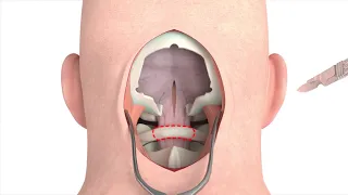 Craniectomy brain surgery - 3D animation