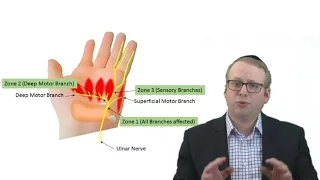 #Ulnar #Tunnel #Syndrome Causes and Treatment