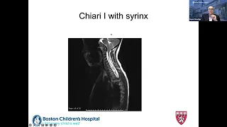Chiari I as an Incidental Finding - Ask the Expert featuring Dr. Mark Proctor