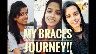 My Journey with Braces | Cost, Types of Braces,Retainers| Everything you need to know!!!