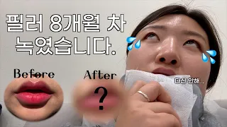 cc) 🇰🇷Removing Lip filler in Korea | Why I decided to remove | K-Beauty Before&After | Birthday Vlog