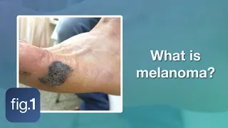 What is melanoma?