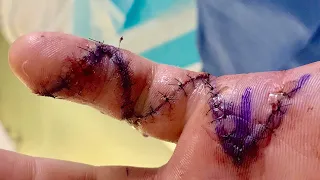 Tv host nearly loses his finger thanks to this accident!