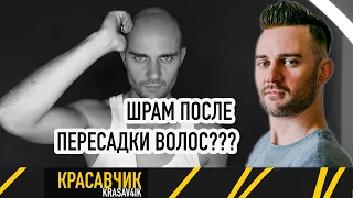 Моя история облысения #2: Получил шрам после пересадки волос! / Красавчик