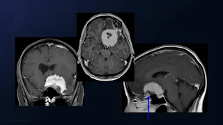 Pterional Craniotomy, Extradural Anterior Clinoidectomy, Resection of Giant Sphenoid Wing Meningioma