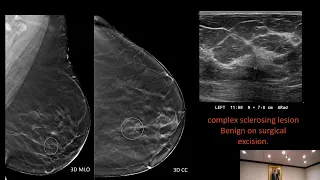 Non-mass findings on Breast Ultrasound: Definitions, discussions, classifications, and etiologies