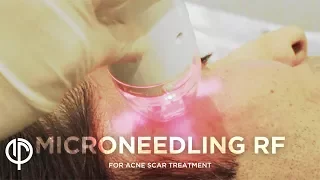 Acne Scar Treatment | Microneedling RF | Acne Scar Treatment Dermatologist | Dr. Jason Emer