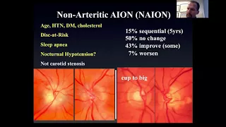 Optic Neuropathy Part 2: Ischemic, Compressive, Hereditary