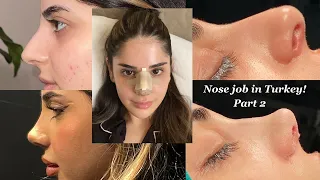 I GOT A NOSE JOB IN TURKEY WITH THE BEST SURGEON! - PART 2 NOSE REVEAL! | CLINICHUB