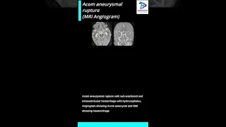 Acom aneurysmal rupture with subarachnoid haemorrhage