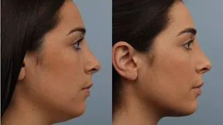 How to Remove Double Chin - Simple Exercises!