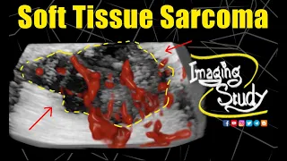 Soft Tissue Sarcoma || Ultrasound || Case 321