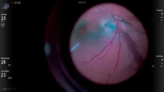 Best of 2020: Gluing an Optic Disc Pit