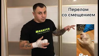 перелом кисти со смещением в кулачке #махач #голыекулаки