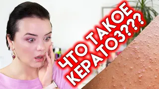 КАК ИЗБАВИТЬСЯ ОТ ГУСИНОЙ КОЖИ на руках? Что такое кератоз и как с ним бороться? | Figurista blog