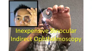 Inexpensive Binocular Indirect Ophthalmoscopy Technique with $30 lens (Without BIO headset)