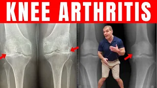 Bow-Legged or Knock-Knee Arthritis? Try this Incredible Trick to Walk Without Pain