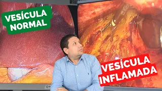 cicatrização da CIRURGIA DE PEDRA NA VESÍCULA!! A cicatrização é sempre igual?