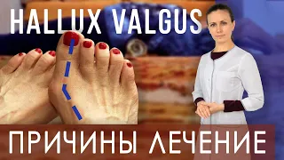 Косточка на ноге. Лечение Hallux valgus дома. Валик под спину | Как правильно лежать на валике