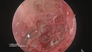 Module 4 Endoscopic Orbital Decompression and Anatomy