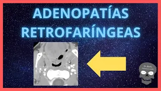 ADENOPATÍAS RETROFARINGEAS👉TRUCO para encontrarlas en las imágenes