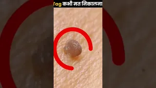 Skin Tags #india #trending #viral #youtube #food #ytshorts #skincare