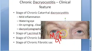 Ophthalmology 402 a Chronic DaCryoCystitis catarrhal mucocele suppurative fibrotic