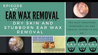 DRY SKIN & STUBBORN EAR WAX REMOVAL - EP437