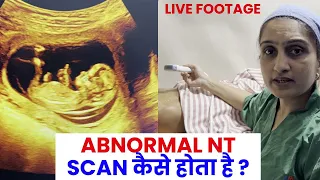 Abnormal NT Scan | Nuchal translucency (NT) scan | Live demo -Dr Asha Gavade
