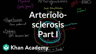 Arteriolosclerosis - part 1 | Circulatory system diseases | Health & Medicine | Khan Academy