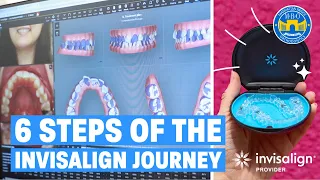 Process of Starting Invisalign Journey