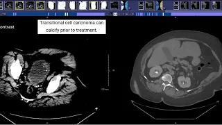 CT Urogram