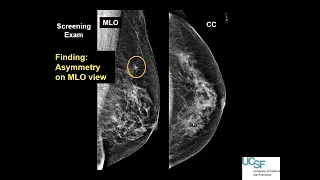 Mammography screening