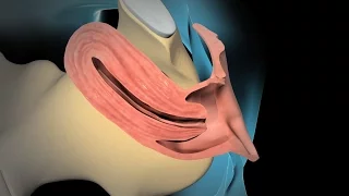 Dilation and Curettage (D & C)