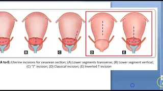 Obstetrics 692 Types of caesarean section csection LSCS Vs classical lower segment benefits when