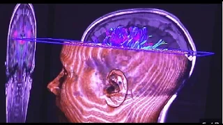 Esquizofrenia, nuevos descubrimientos psiquiátricos.