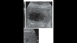 Ultrasound of Pyogenic Liver Abcess ( from the book Requisites)