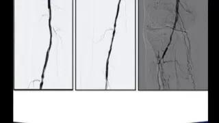 Complex Interventional Techniques Chapter 7 Day 1 Live Stream