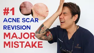 What to consider BEFORE acne scar revision| Dermatologist Guide