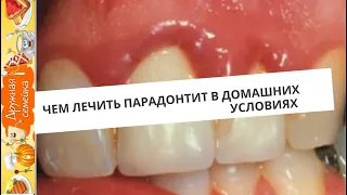 Как лечить парадонтит в домашних условиях