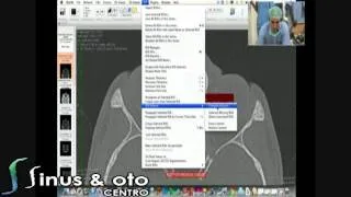 Segmenting and volume rendering on Osirix (Lecture)