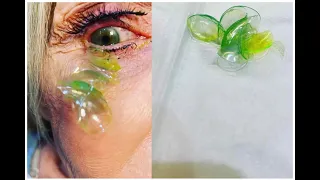 The doctor removed 23 contact lenses from the woman's eye