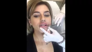Увеличение губ при помощи инъекции