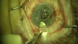 Patch endothelial keratoplasty (PEK) for corneal perforation
