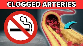 Doing These 5 Things EXCESSIVELY Will PERMANENTLY Clog Arteries | Vitality Solutions