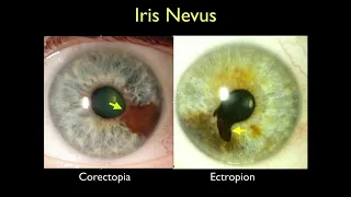 COR06 07   Section V Anterior Segment Tumors   Management of Pigmented Iris Lesions When Should I Wo