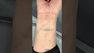 TATTOO REMOVAL results after 6 sessions! 🖊👋| Dr. Medispa