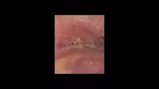 Satisfying Blackheads Removal!