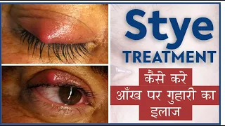 Easy Stye treatment at Home | Doctors tips for Stye Eye infection | कैसे करे आँख पर गुहरी का इलाज |