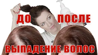 Выпадение волос-что делать?